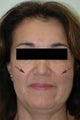 Restylane for laugh lines