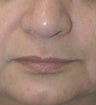 Restylane for marionette (mouth) lines