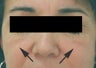 Restylane injections for cheek augmentation