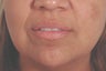 Restylane for laugh lines