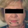 Oral Commissures (marionette lines) with Restylane Treatment