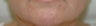Restylane and Botox for mouth rejuvenation