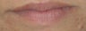 Lip enhancement with Restylane