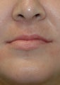 Restylane lip injections