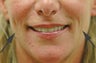 Restylane for cheek augmentation