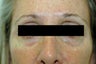 Restylane for dark circles under the eyes