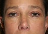 Rhinoplasty