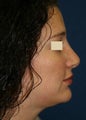 Revision Rhinoplasty