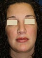 Revision Rhinoplasty