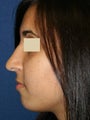Rhinoplasty revision