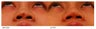 Asian Rhinoplasty