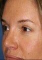 Rhinoplasty and Brow Lift