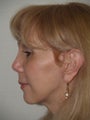 Revision rhinoplasty