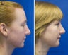 Revision Rhinoplasty, Chin Implantation, Mole Excision