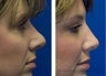 Revision Rhinoplasty