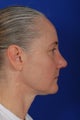 Revision Rhinoplasty