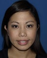 Revision Rhinoplasty with Chin Implant