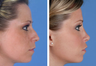 Revision Rhinoplasty