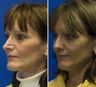 Revision Rhinoplasty