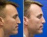 Revision Rhinoplasty with Rib cartilage graft