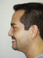 Revision Rhinoplasty