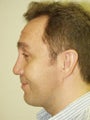 Revision Rhinoplasty