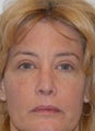 Revision Rhinoplasty and Eyelid Surgery