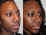 Revision Rhinoplasty