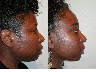 Revision Rhinoplasty