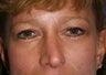 Rhinoplasty