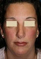 Revision Rhinoplasty