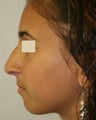 Rhinoplasty revision