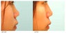Asian Rhinoplasty