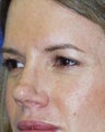 Rhinoplasty and Brow Lift