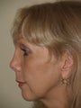 Revision rhinoplasty