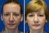 Revision Rhinoplasty, Chin Implantation, Mole Excision