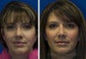 Revision Rhinoplasty