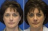 Revision Rhinoplasty