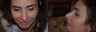 Revision rhinoplasty