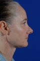 Revision Rhinoplasty