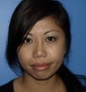 Revision Rhinoplasty with Chin Implant