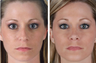 Revision Rhinoplasty