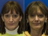 Revision Rhinoplasty