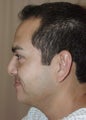 Revision Rhinoplasty