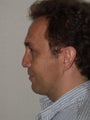 Revision Rhinoplasty