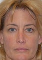 Revision Rhinoplasty and Eyelid Surgery