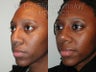 Revision Rhinoplasty