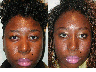 Revision Rhinoplasty