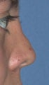 Rhinoplasty - Surgical Revision