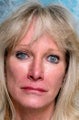Revising cheek implants and fixing eyelids